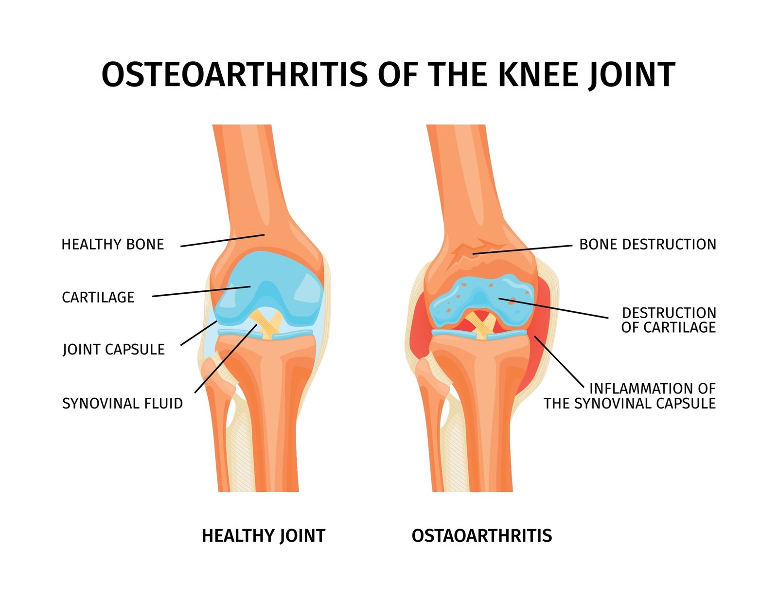 Healthy Knee vs Arthritic Knee Comparison